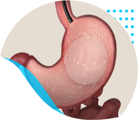 Orbera® Intragastric Balloon