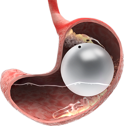 Why Orbera® Intragastric Balloon